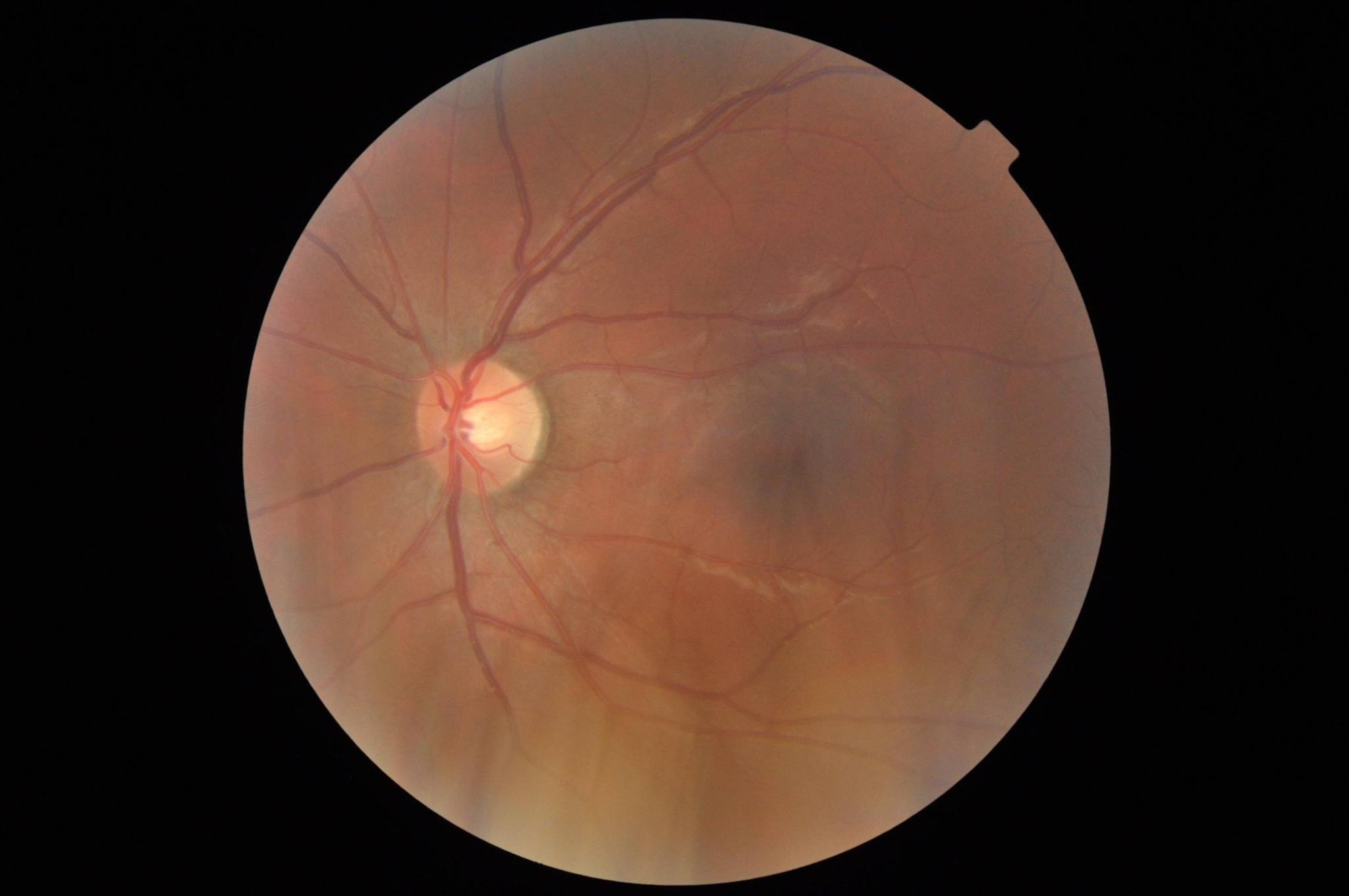 Take good care of your eyes, you can only screw it up twice.